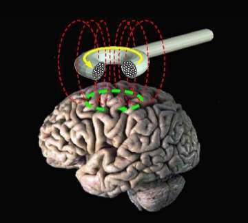 transcranial_magnetic_stimulation
